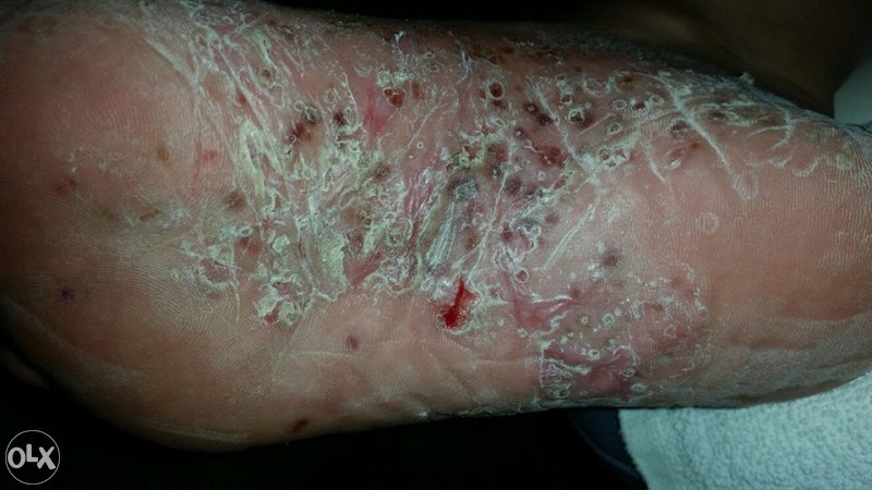 KREMA ZA PSORIJAZU - PSORILUX KREMA