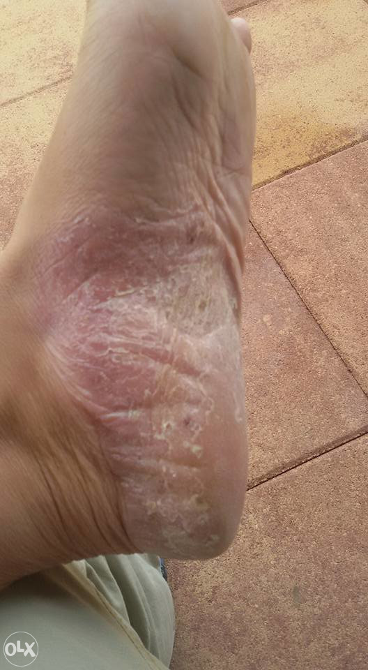 KREMA ZA PSORIJAZU - PSORILUX KREMA